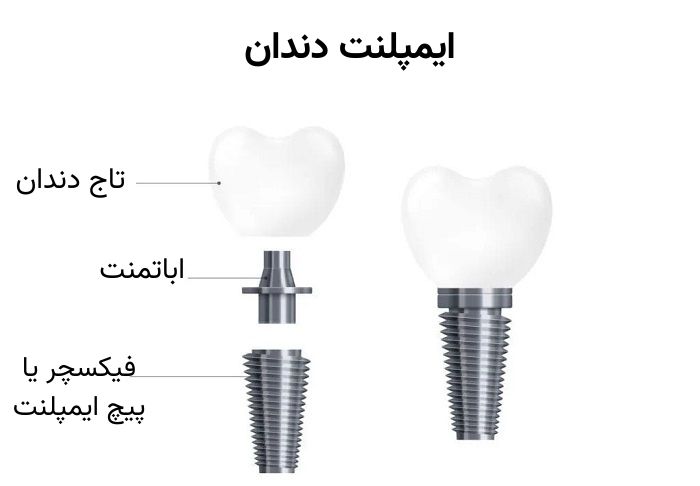اجزای ایمپلنت دندان