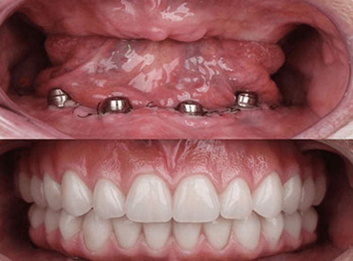 ایمپلنت دندان چیست؟