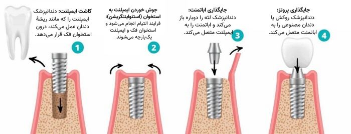 فرایند کاشت ایمپلنت دندان
