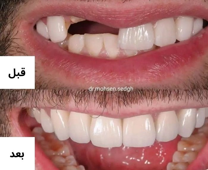 مزایا و معایب ایمپلنت دندان