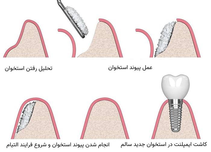 پیوند استخوان برای ایمپلنت دندان