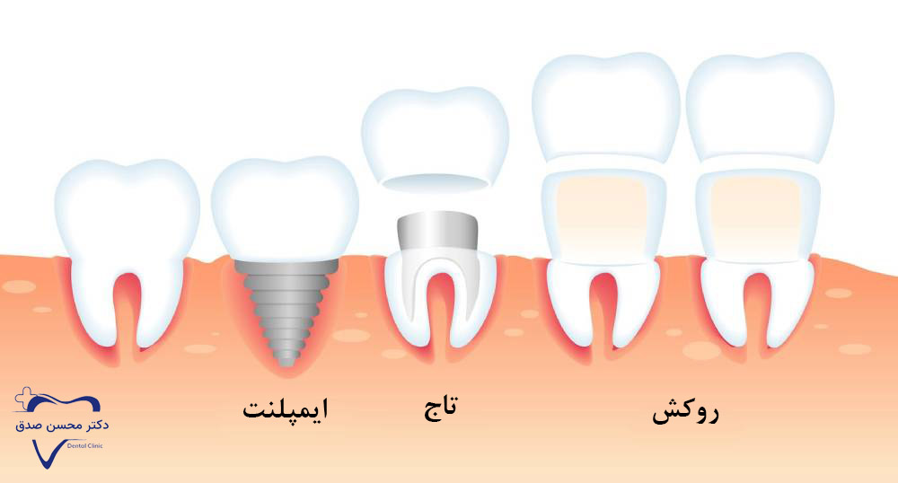 تفاوت روکش دندان با کامپوزیت، لمینت و ایمپلنت