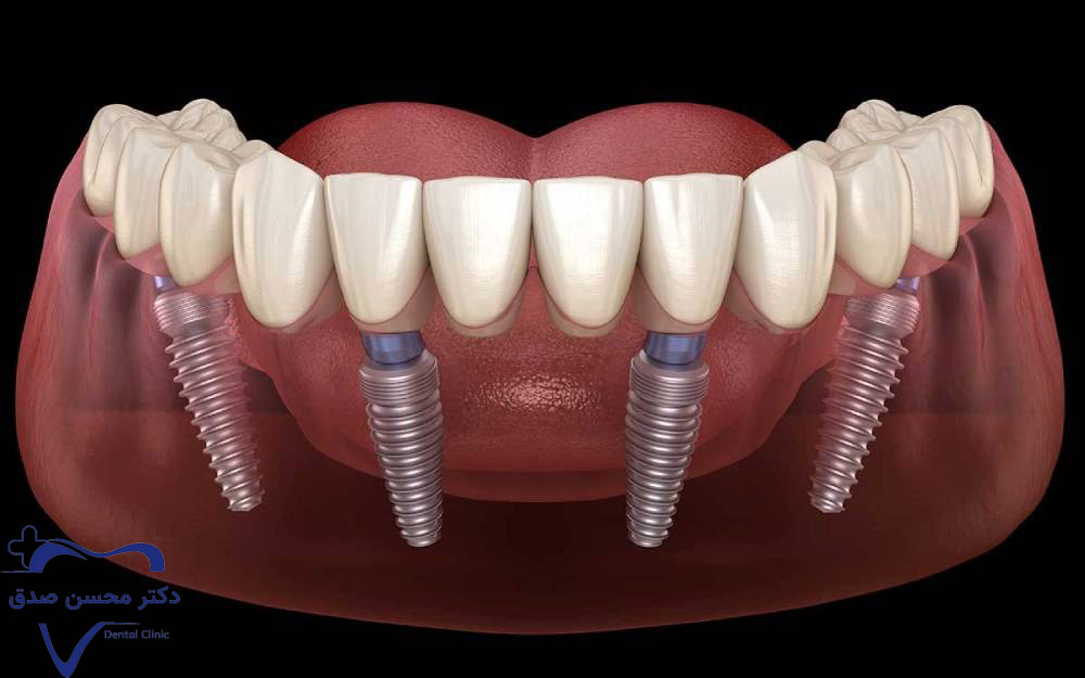 جایگزینی چند دندان با ایمپلنت فوری