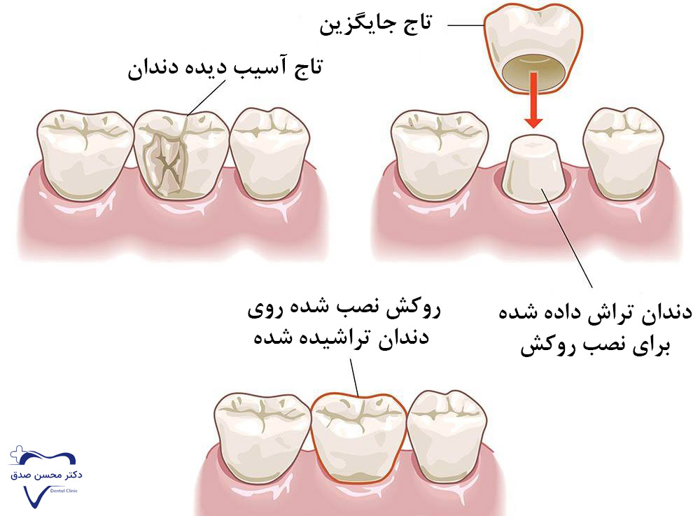 روکش دندان چیست؟