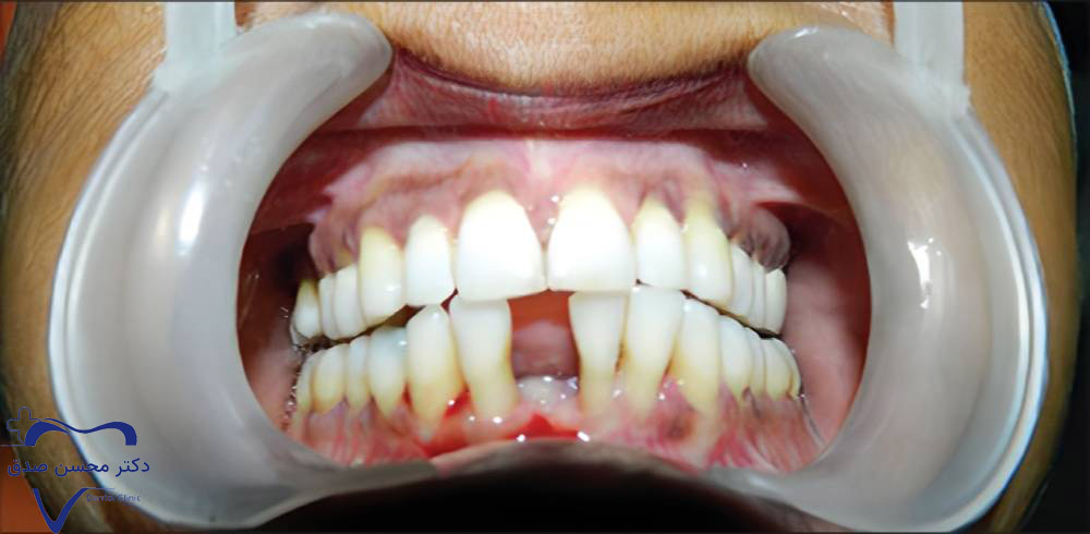 کشیدن دندان قبل از ایمپلنت