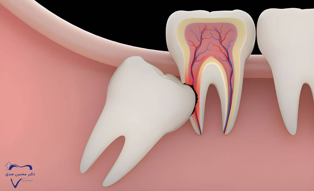 آسیب به دندان‌های مجاور به دلیل نکشیدن دندان عقل