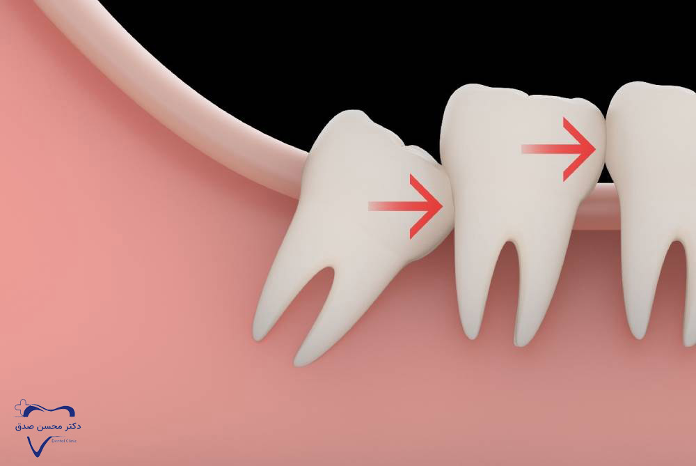 به هم ریختن دندان‌ها به دلیل نکشیدن دندان عقل