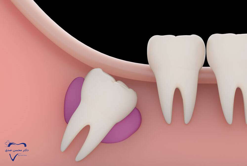 تشکیل کیست به دلیل نکشیدن دندان عقل