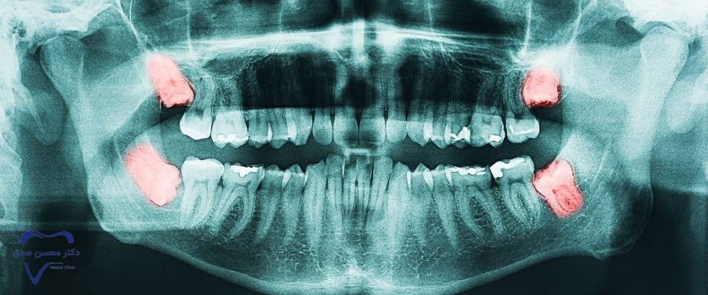 دندان عقل نهفته و دردسرهای آن