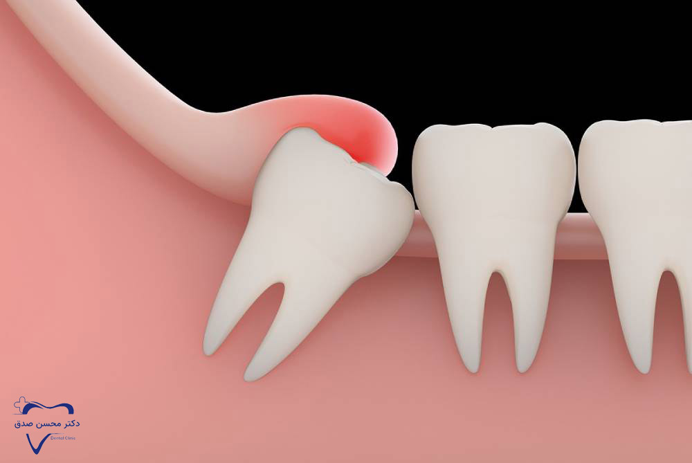 عفونت لثه و استخوان به دلیل نکشیدن دندان عقل