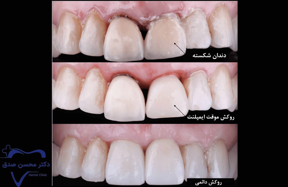 نصب پروتز موقت برای کاشت ایمپلنت دندان