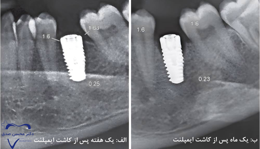 جوش خوردن پایۀ ایمپلنت به استخوان