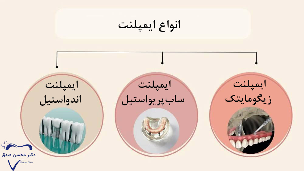 رایج‌ترین نوع ایمپلنت برای دندان جلو