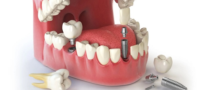 ایمپلنت تک‌دندانی