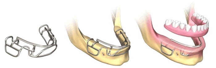 ایمپلنت ساب‌پریواستیل