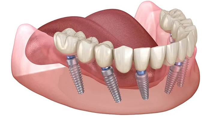 ایمپلنت کل دهان