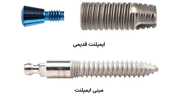 مینی ایمپلنت