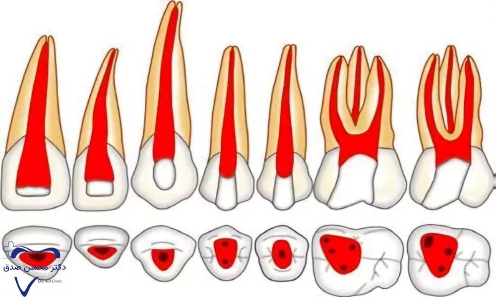 عصب کشی دندان تک کاناله، دوکاناله، سه کاناله و چهار کاناله