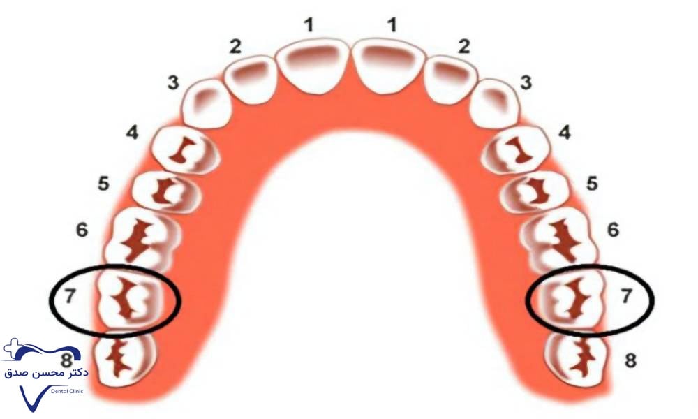 عصب کشی دندان شماره هفت