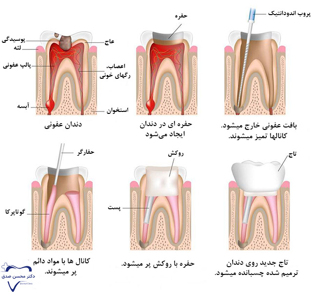 نحوه عصب کشی دندان