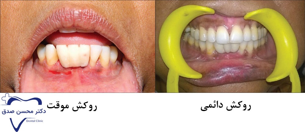 نصب روکش موقت و دائمی ایمپلنت