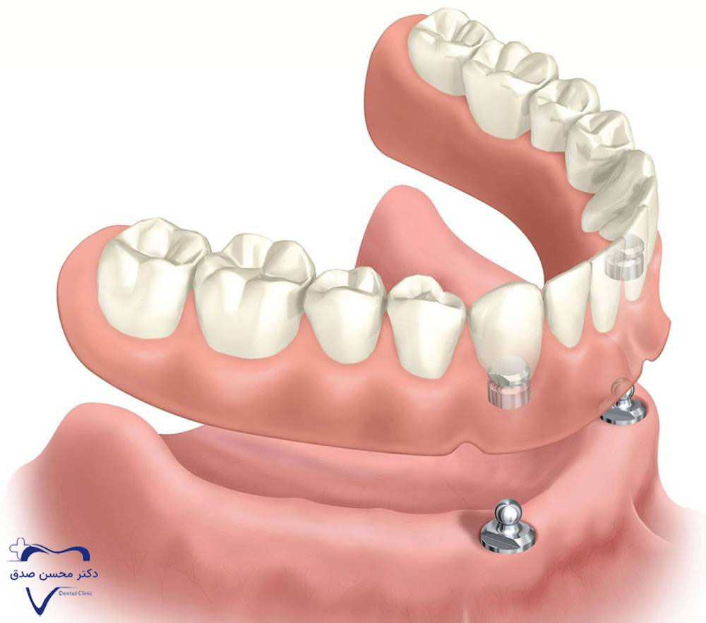 ایمپلنت All-on-2