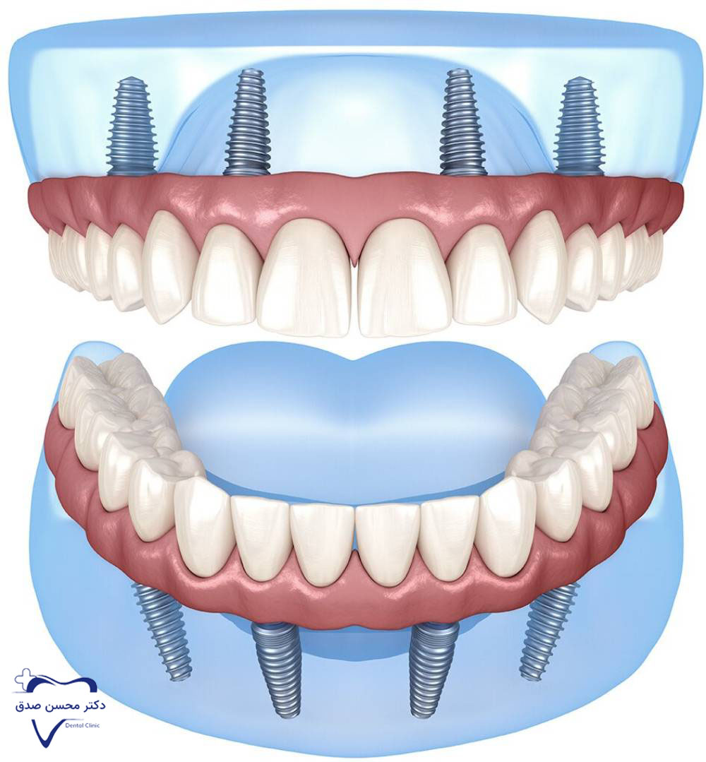 ایمپلنت All-on-4