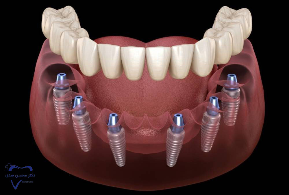 ایمپلنت All-on-6