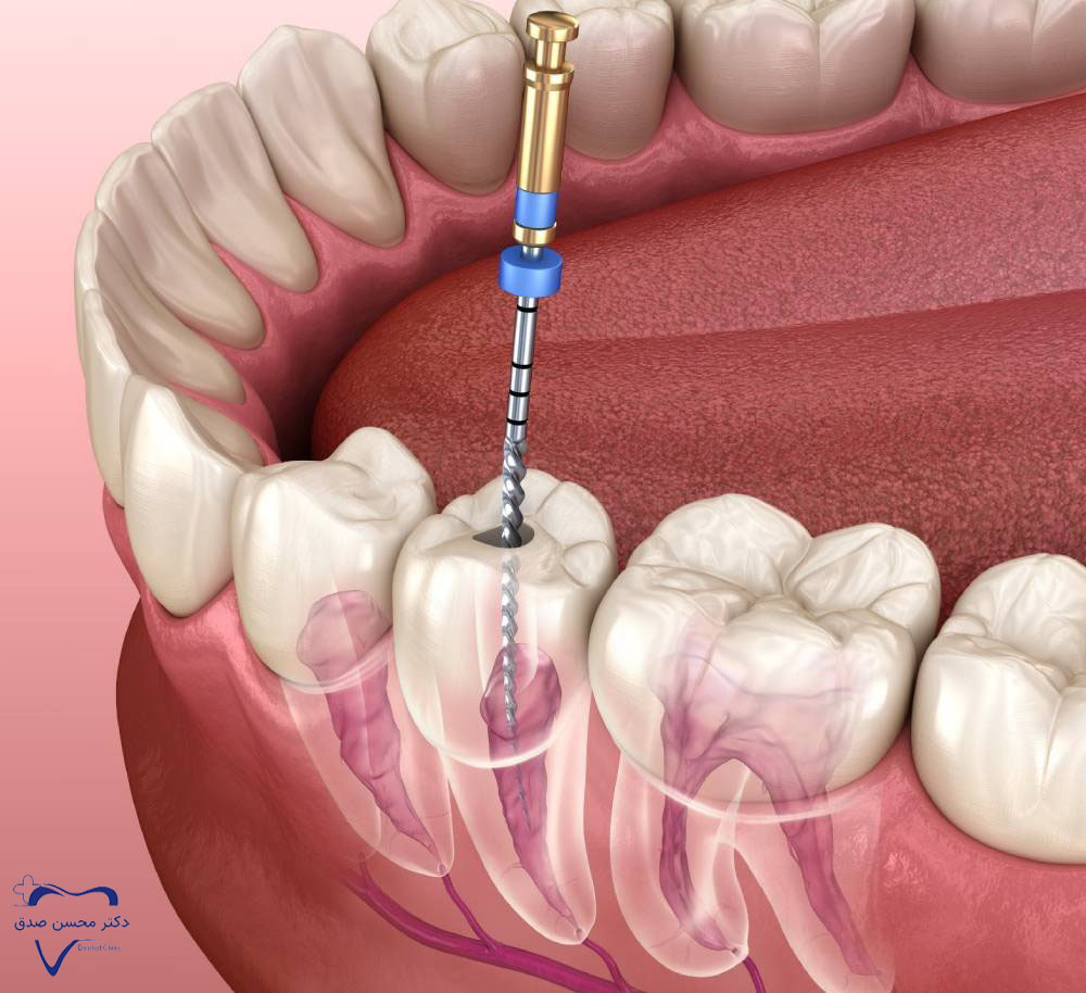دندان عصب کشی شده