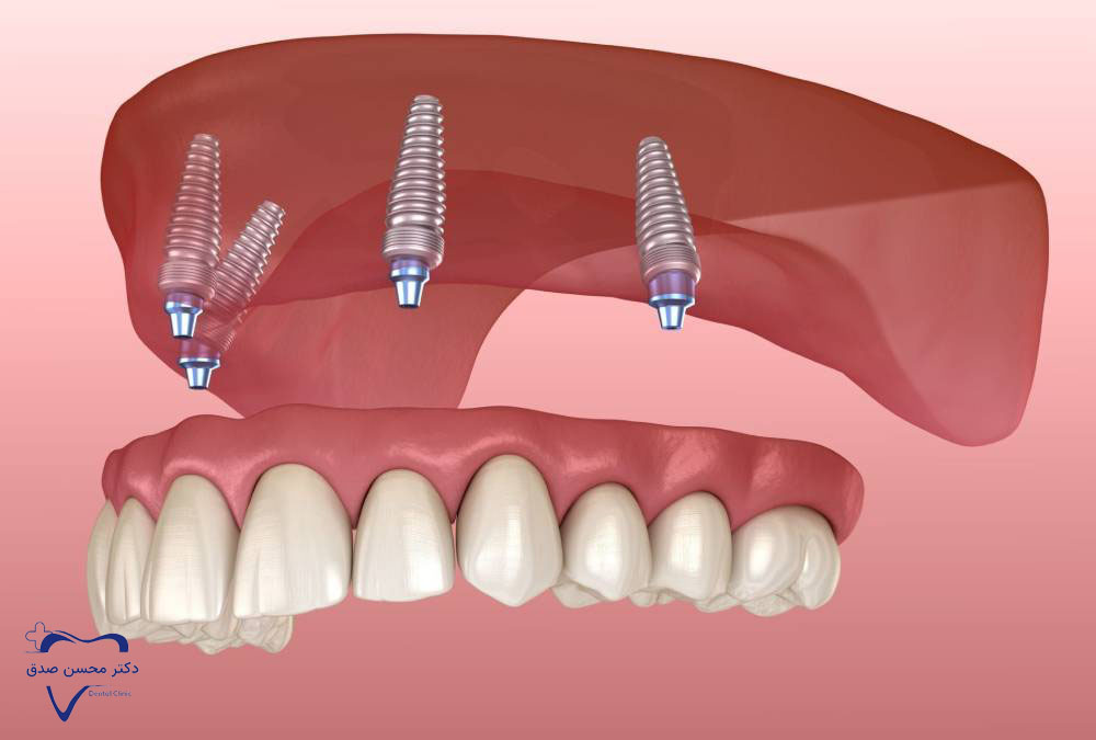 دندان مصنوعی ثابت بر پایه ایمپلنت (اوردنچر)