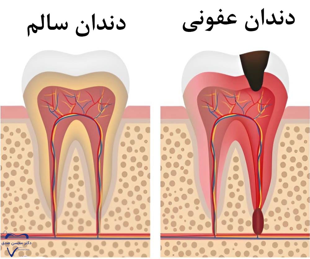 عفونت دندان چیست