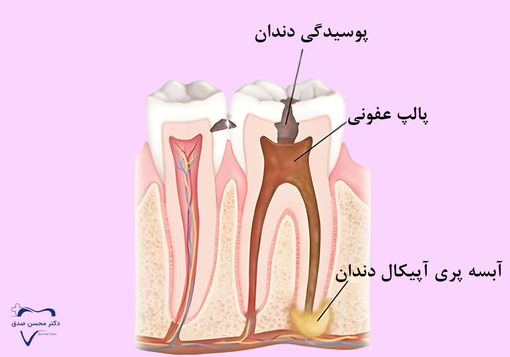 آبسه پری آپیکال