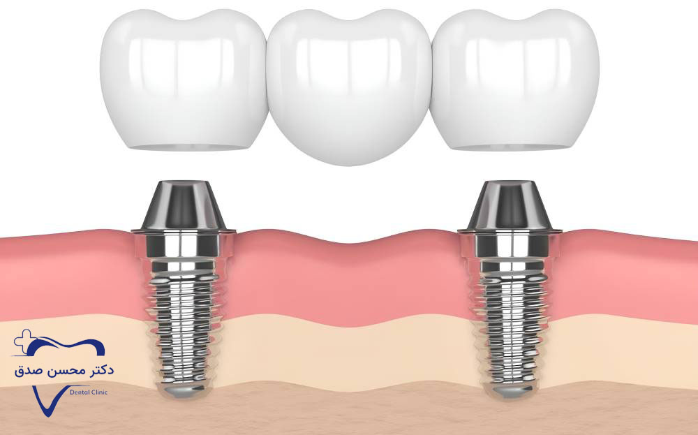 بریج دندان بر پایه ایمپلنت