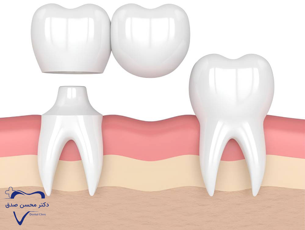 بریج دندان کنسولی یا معلق