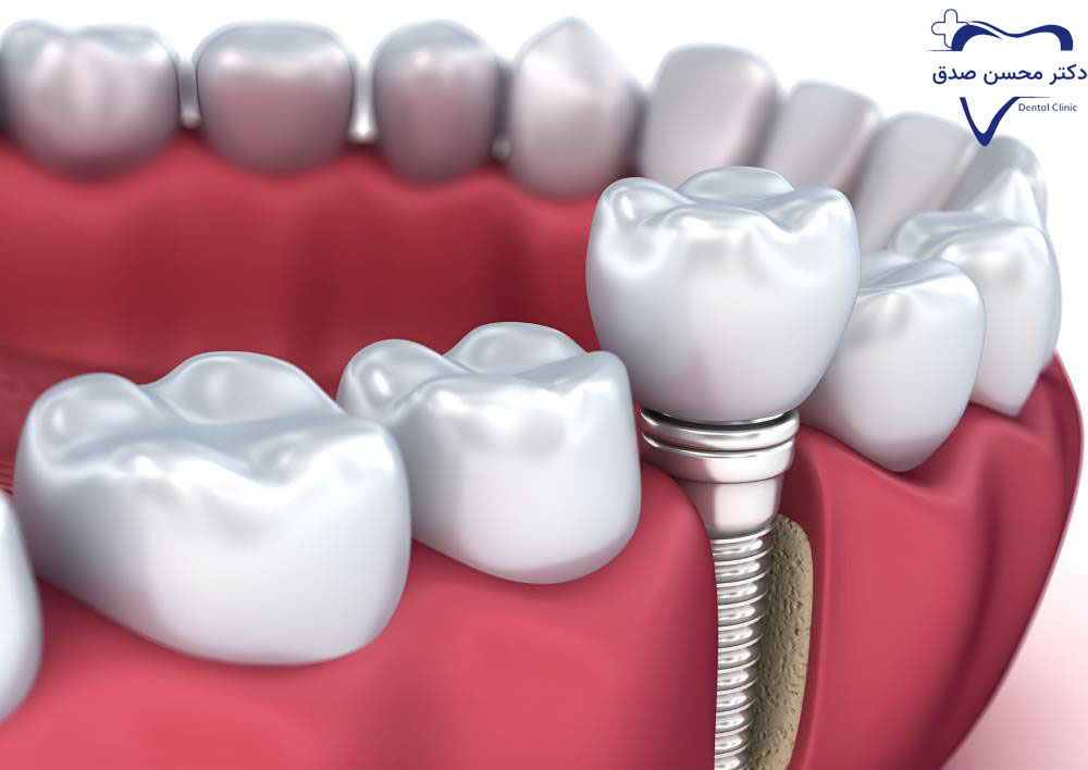 ترمیم دندان شکسته با ایمپلنت دندان