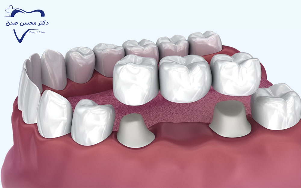 بریج دندان برای ترمیم دندان شکسته 