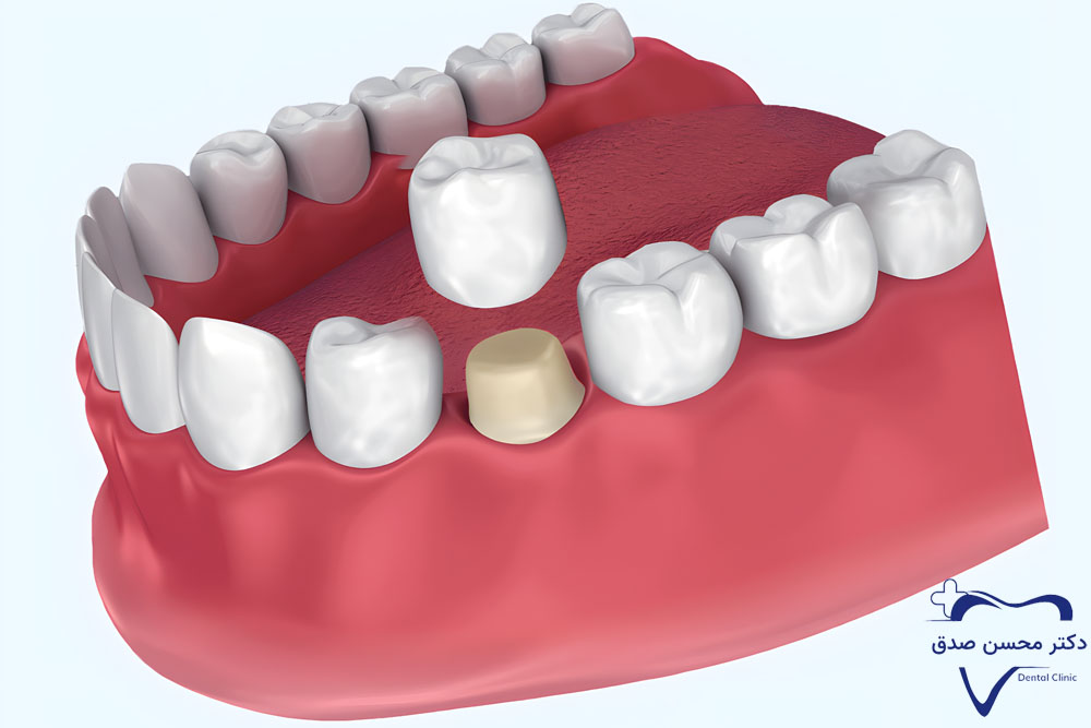 ترمیم دندان شکسته با روکش دندان