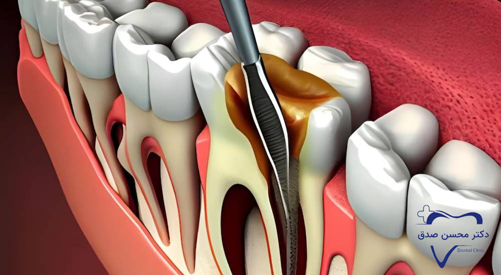 عصب کشی برای درمان پوسیدگی دندان 