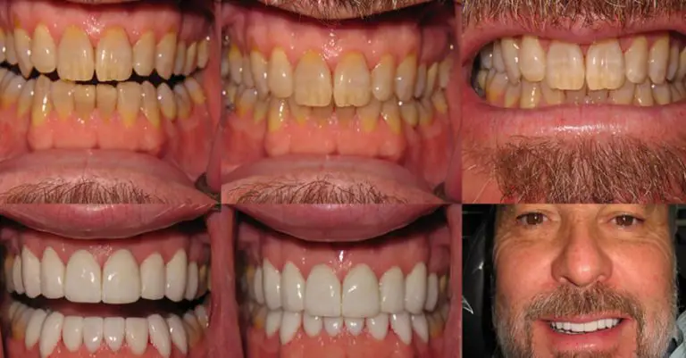 تفاوت قیمت لمینت دندان در خارج و ایران